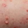 Contagious Skin Rashes