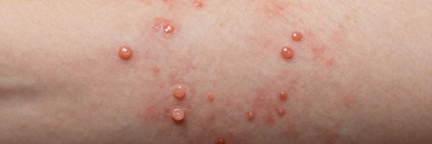 Contagious Skin Rashes