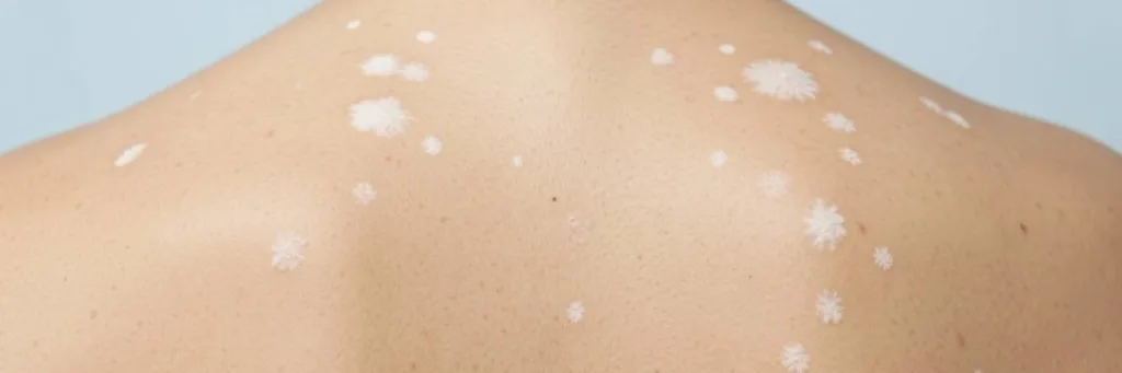 What Is White Fungus
