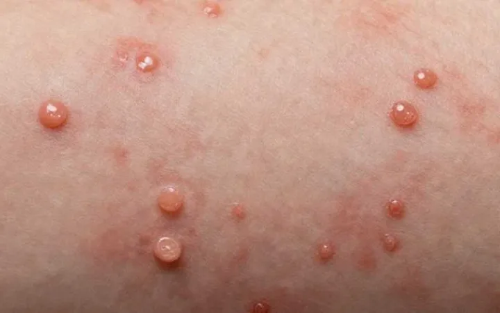 Contagious Skin Rashes
