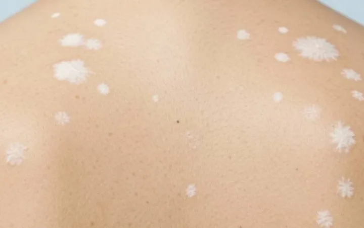 What Is White Fungus